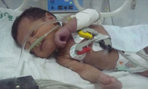 Gaza kids born with defects following 22-day war