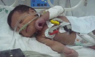 Gaza kids born with defects following 22-day war
