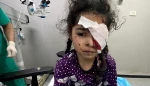 The Ministry of Health in the Gaza Strip has said that around 1,500 citizens have lost their eyesight in the besieged enclave as a result of the ongoing Israeli war of genocide on the Strip while about 4,000 others are threatened with the same fate.
