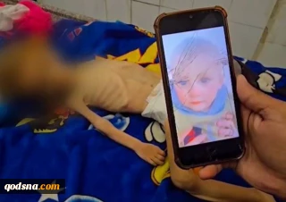 شهادت ۶۹ کودک در غزه به دلیل سوءتغذیه/ پزشک انگلیسی: نظامیان صهیونیست کودکان فلسطینی را هدفمند و با الگوهای مشخص در بدن هدف تیراندازی قرار می‌دهند
