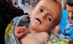 منابع پزشکی فلسطینی گزارش دادند:
سوءتغذیه شدید ۱۷ هزار کودک فلسطینی/ یک کودک شیرخواره دیگر شهید شد 2