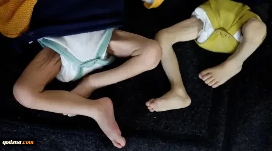 بينهم طفل.. سوء التغذية يحصد 5 شهداء جدد ليرفع حصيلتهم لـ222 شهيدًا 2