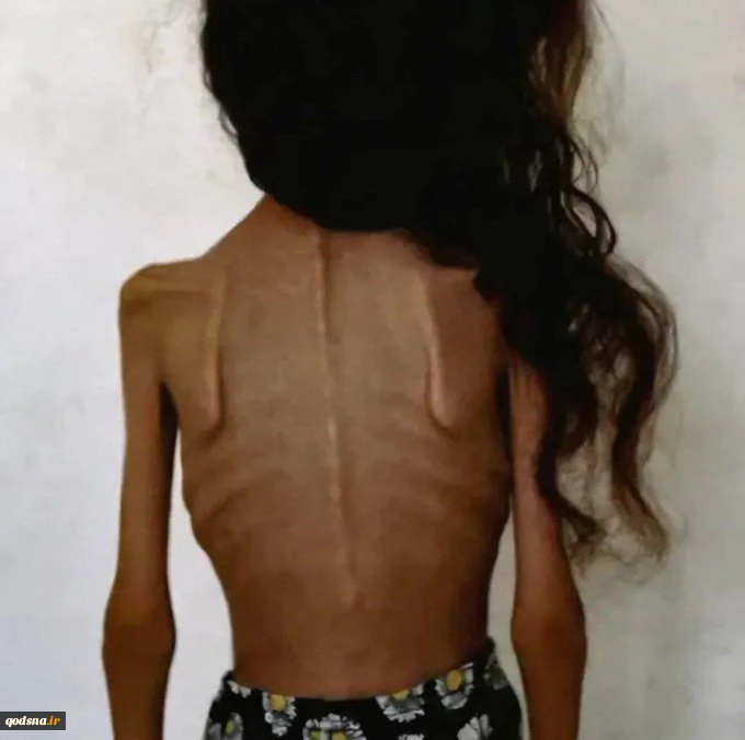 Child Muhammad Khader dies of hunger in Khan Yunis