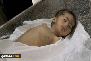هشدار آنروا: سوء تغذیه کودکان غزه شدت گرفته است