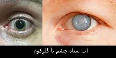 وزارت بهداشت نوار غزه : هزاران نفر با خطر نابینایی قرار دارند 2