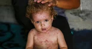 Skin infections surge in Gaza due to medicine shortages amid Israeli blockade: UNRWA